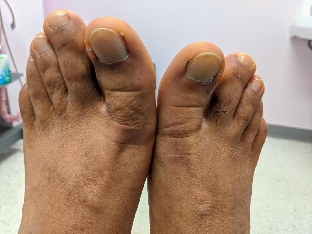 toenail fungus treatment